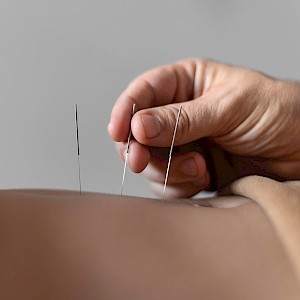 acupuncture-hand.jpg|acupuncture-woman.jpg->first->description